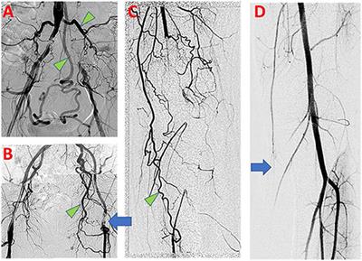 Structural Remodeling of the Extracellular Matrix in Arteriogenesis: A Review